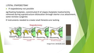 2)TOTAL STAPEDECTOMY
 If stapedotomy not possible
eg:floating footplate, comminuted # of stapes,footplate inadvertently
removed during suprastructure dislocation through nterior crus attachment,
some revision surgeries
If instruments needed to create small fenestra are lacking
 
