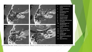 Otosclerosis