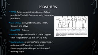 Otosclerosis | PPTX