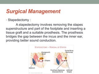 Surgical Management
• Stapedectomy :
A stapedectomy involves removing the stapes
superstructure and part of the footplate and inserting a
tissue graft and a suitable prosthesis. The prosthesis
bridges the gap between the incus and the inner ear,
providing better sound conduction.
 