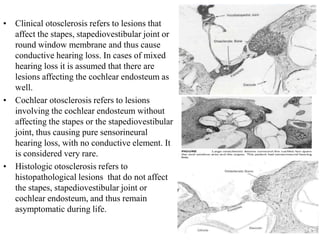• Clinical otosclerosis refers to lesions that
affect the stapes, stapediovestibular joint or
round window membrane and thus cause
conductive hearing loss. In cases of mixed
hearing loss it is assumed that there are
lesions affecting the cochlear endosteum as
well.
• Cochlear otosclerosis refers to lesions
involving the cochlear endosteum without
affecting the stapes or the stapediovestibular
joint, thus causing pure sensorineural
hearing loss, with no conductive element. It
is considered very rare.
• Histologic otosclerosis refers to
histopathological lesions that do not affect
the stapes, stapediovestibular joint or
cochlear endosteum, and thus remain
asymptomatic during life.
 