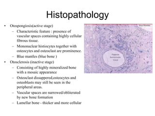 Histopathology
• Otospongiosis(active stage)
– Characteristic feature : presence of
vascular spaces containing highly cellular
fibrous tissue.
– Mononuclear histiocytes together with
osteocytes and osteoclast are prominence.
– Blue mantles (blue bone )
• Otosclerosis (inactive stage)
– Consisting of highly mineralized bone
with a mosaic appearance
– Osteoclast dissappered,osteocytes and
osteoblasts may still be seen in the
peripheral areas.
– Vascular spaces are narrowed/obliterated
by new bone formation
– Lamellar bone - thicker and more cellular
 