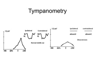 Tympanometry
 