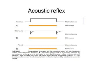 Acoustic reflex
 