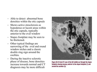 – Able to detect abnormal bone
densities within the otic capsule
– Shows active otosclerosis as
hypodense or lucent areas within
the otic capsule, typically
anterior to the oval window
– Stapes footplate may be seen to
be thickened.
– Other typical findings are
narrowing of the oval and round
window niches and a classic
double ring sign around the
cochlea.
– During the inactive sclerotic
phase of disease, bone densities
increase towards normal and CT
diagnosis may be more difficult
 