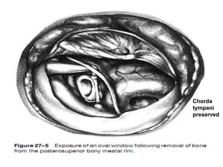 Chorda
tympani
preserved
 
