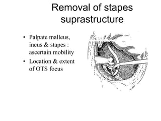 Removal of stapes
suprastructure
• Palpate malleus,
incus & stapes :
ascertain mobility
• Location & extent
of OTS focus
 