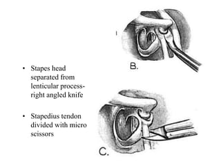 • Stapes head
separated from
lenticular process-
right angled knife
• Stapedius tendon
divided with micro
scissors
 