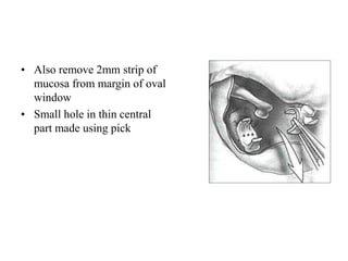 • Also remove 2mm strip of
mucosa from margin of oval
window
• Small hole in thin central
part made using pick
 