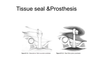 Tissue seal &Prosthesis
 