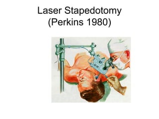 Laser Stapedotomy
(Perkins 1980)
 