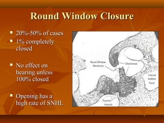 Round Window Closure
   20%-50% of cases
   1% completely
    closed

   No effect on
    hearing unless
    100% closed

   Opening has a
    high rate of SNHL
 