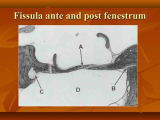 Fissula ante and post fenestrum
 