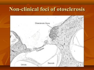 Non-clinical foci of otosclerosis
 