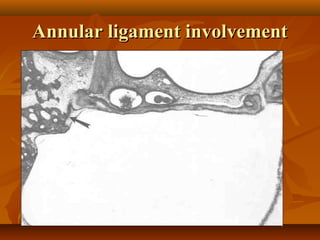 Annular ligament involvement
 