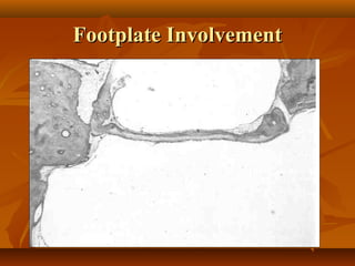 Footplate Involvement
 