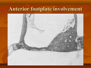 Anterior footplate involvement
 