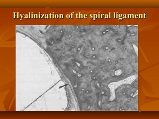 Hyalinization of the spiral ligament
 