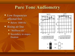 Pure Tone Audiometry
   Low frequencies
    affected first
       Below 1000 Hz
   Rising air line
       “Stiffness tilt”
       Secondary to stapes
        fixation
 