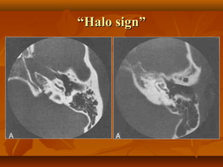 “Halo sign”
 