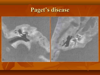 Paget’s disease
 