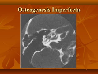 Osteogenesis Imperfecta
 