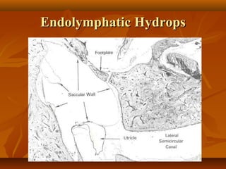 Endolymphatic Hydrops
 