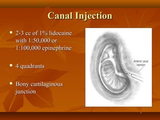 Canal Injection
   2-3 cc of 1% lidocaine
    with 1:50,000 or
    1:100,000 epinephrine

   4 quadrants

   Bony cartilaginous
    junction
 