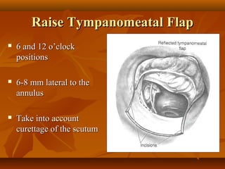 Raise Tympanomeatal Flap
   6 and 12 o’clock
    positions

   6-8 mm lateral to the
    annulus

   Take into account
    curettage of the scutum
 