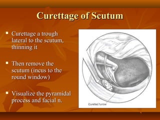 Curettage of Scutum
   Curettage a trough
    lateral to the scutum,
    thinning it

   Then remove the
    scutum (incus to the
    round window)

   Visualize the pyramidal
    process and facial n.
 