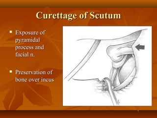 Curettage of Scutum
   Exposure of
    pyramidal
    process and
    facial n.

   Preservation of
    bone over incus
 