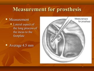 Measurement for prosthesis
   Measurement
       Lateral aspect of
        the long process of
        the incus to the
        footplate

   Average 4.5 mm
 