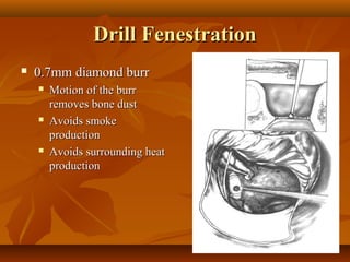 Drill Fenestration
   0.7mm diamond burr
       Motion of the burr
        removes bone dust
       Avoids smoke
        production
       Avoids surrounding heat
        production
 