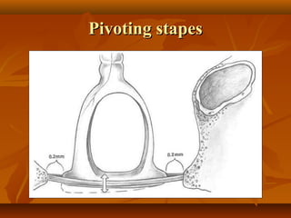 Pivoting stapes
 