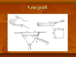 Vein graft
 