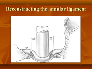 Reconstructing the annular ligament
 