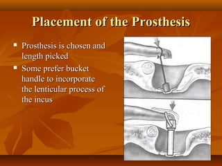 Placement of the Prosthesis
   Prosthesis is chosen and
    length picked
   Some prefer bucket
    handle to incorporate
    the lenticular process of
    the incus
 