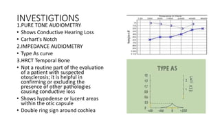 INVESTIGTIONS
1.PURE TONE AUDIOMETRY
• Shows Conductive Hearing Loss
• Carhart's Notch
2.IMPEDANCE AUDIOMETRY
• Type As curve
3.HRCT Temporal Bone
• Not a routine part of the evaluation
of a patient with suspected
otosclerosis; it is helpful in
confirming or excluding the
presence of other pathologies
causing conductive loss
• Shows hypodense or lucent areas
within the otic capsule
• Double ring sign around cochlea
 