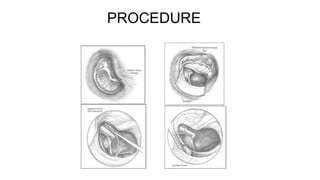 PROCEDURE
 