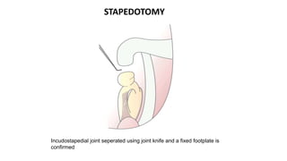 Incudostapedial joint seperated using joint knife and a fixed footplate is
confirmed
STAPEDOTOMY
 
