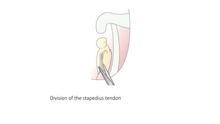 Division of the stapedius tendon
 