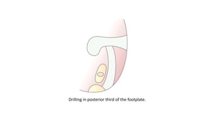 Drilling in posterior third of the footplate.
 