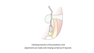 Following insertion of the prosthesis, final
adjustments are made and crimping carried out if required.
 