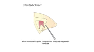 STAPEDECTOMY
After division with picks, the posterior footplate fragment is
removed.
 