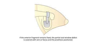 If the anterior fragment remains fixed, the partial oval window defect
is covered with vein or fascia and the prosthesis positioned.
 