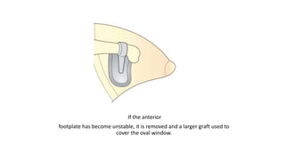 If the anterior
footplate has become unstable, it is removed and a larger graft used to
cover the oval window.
 