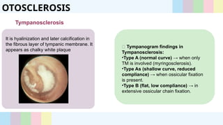 Tm Sclerosis otosclerosis- history, pathology, stapedectomy | PPTX