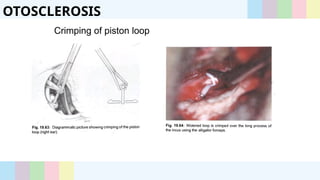 otosclerosis- history, pathology, stapedectomy | PPTX
