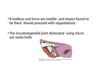 otosclerosis.pptent ppT clinical features eyiology pathogenesis | PPTX