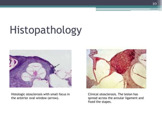 Histopathology
10
Histologic otosclerosis with small focus in
the anterior oval window (arrow).
Clinical otosclerosis. The lesion has
spread across the annular ligament and
fixed the stapes.
 